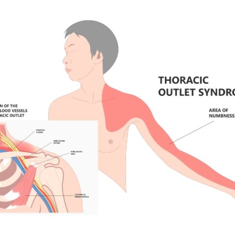 Thoracic Outlet Syndrome - Shanti