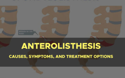 Understanding Anterolisthesis: Causes, Symptoms, and Treatment Options