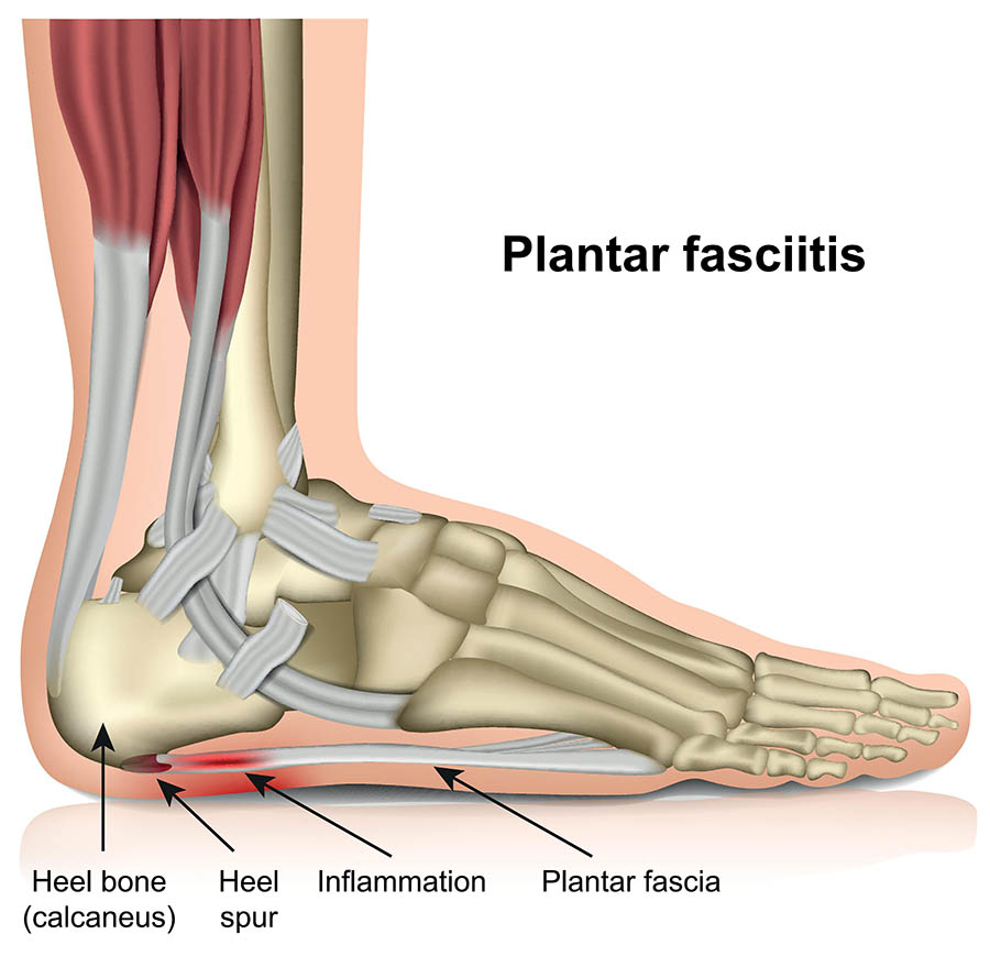 Exercises for Plantar Fasciitis