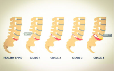 Anterolisthesis Grade Classification: Understanding Severity Levels, Diagnosis & Recovery Expectations